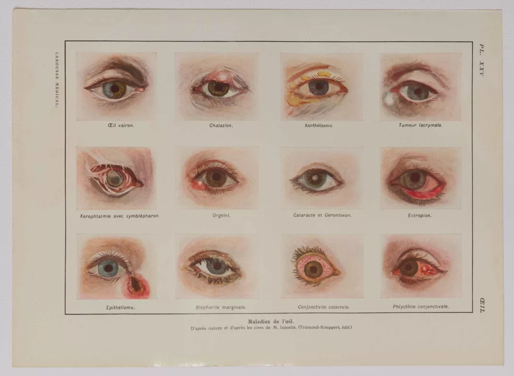 Maladies de l’œil, planche médicale 1924