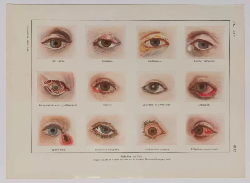 Maladies de l’œil, planche médicale 1924