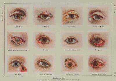 Maladies de l’œil, planche médicale 1924