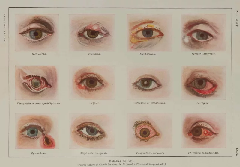 Maladies de l’œil, planche médicale 1924