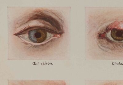 Maladies de l’œil, planche médicale 1924