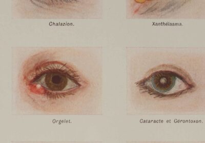 Maladies de l’œil, planche médicale 1924